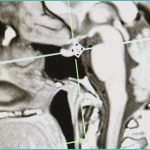 cannabis intoxication disrupts many types of memor