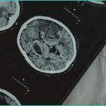 study finds smoking weed and tobacco accelerates b
