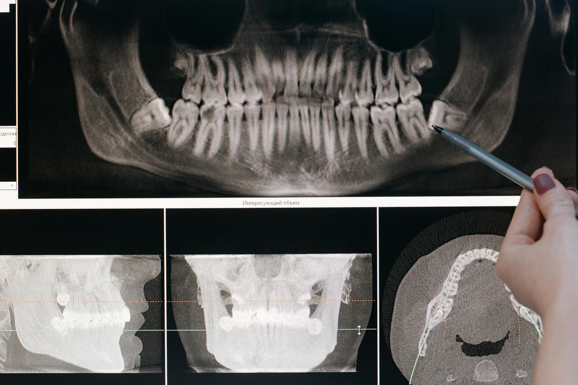 Do Cannabis Users Require More Anesthesia During Third Molar Removal Under Intravenous General Anesthesia When Compared to Nonusers?
