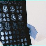long term cannabis use alters brain structure fe