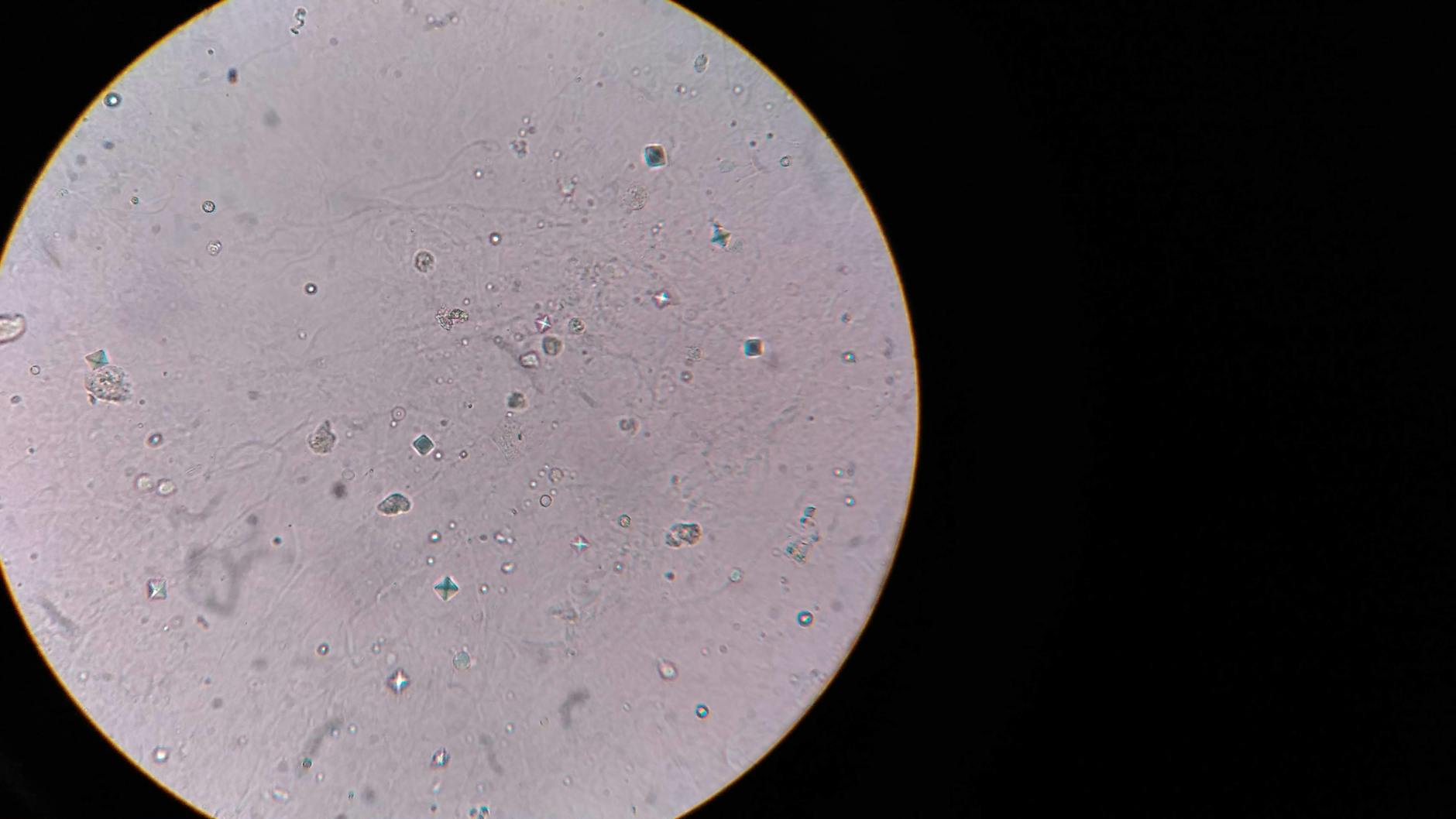 Tuberculous Peripancreatic Lymphadenitis Presenting as Obstructive Jaundice Due to Extrinsic Common Bile Duct Compression: A Case Report.