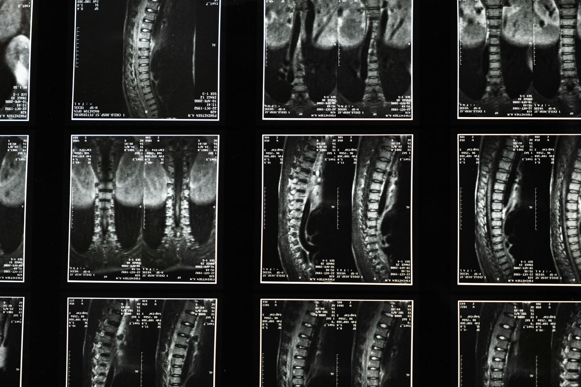 Neuropathic Pain Severity Is Associated With Opioid Use in Adults With Traumatic Spinal Cord Injury: A Spinal Cord Injury Model System Study.