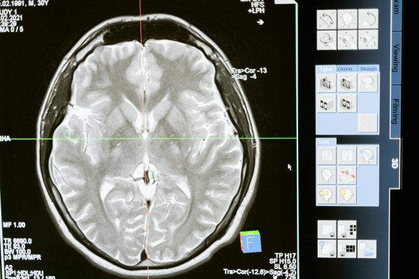CED Clinic: Personalized Cannabis Medicine 383 CBD:THC Ratios Show Neuroprotection in Brain Injury Study – CED Clinic