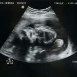 Can the placenta predict schizophrenia risk? Lessons from prenatal cannabis exposure