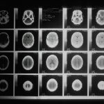 Black and white brain MRI images, representing neuroscience research into cannabis and Tourette syndrome