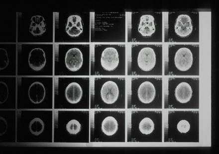 Black and white brain MRI images, representing neuroscience research into cannabis and Tourette syndrome