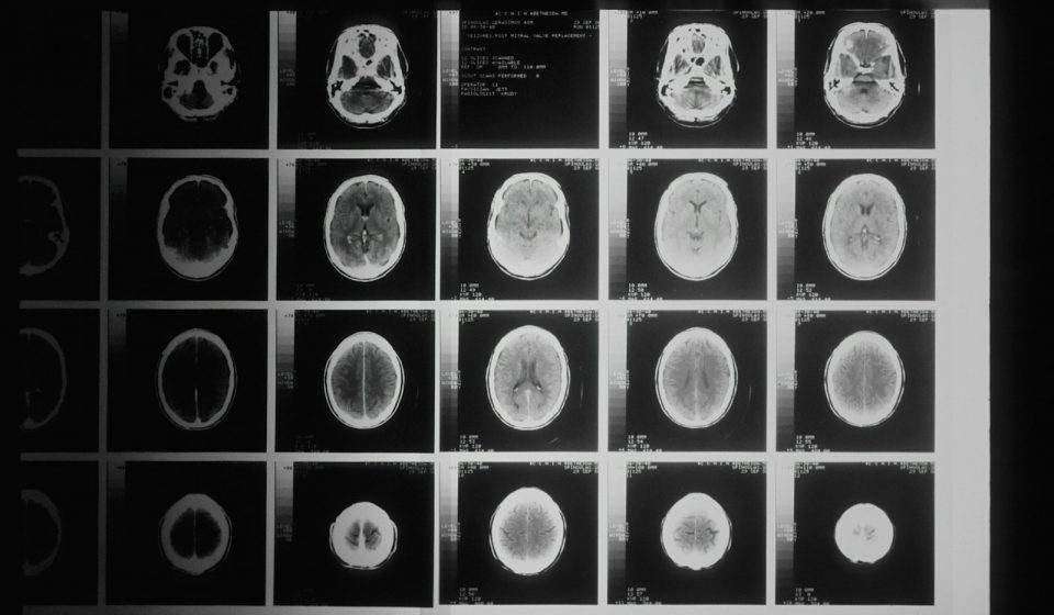 Black and white brain MRI images, representing neuroscience research into cannabis and Tourette syndrome