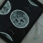 RECAP: Neurology News Network - Week of July 25th | NeurologyLive